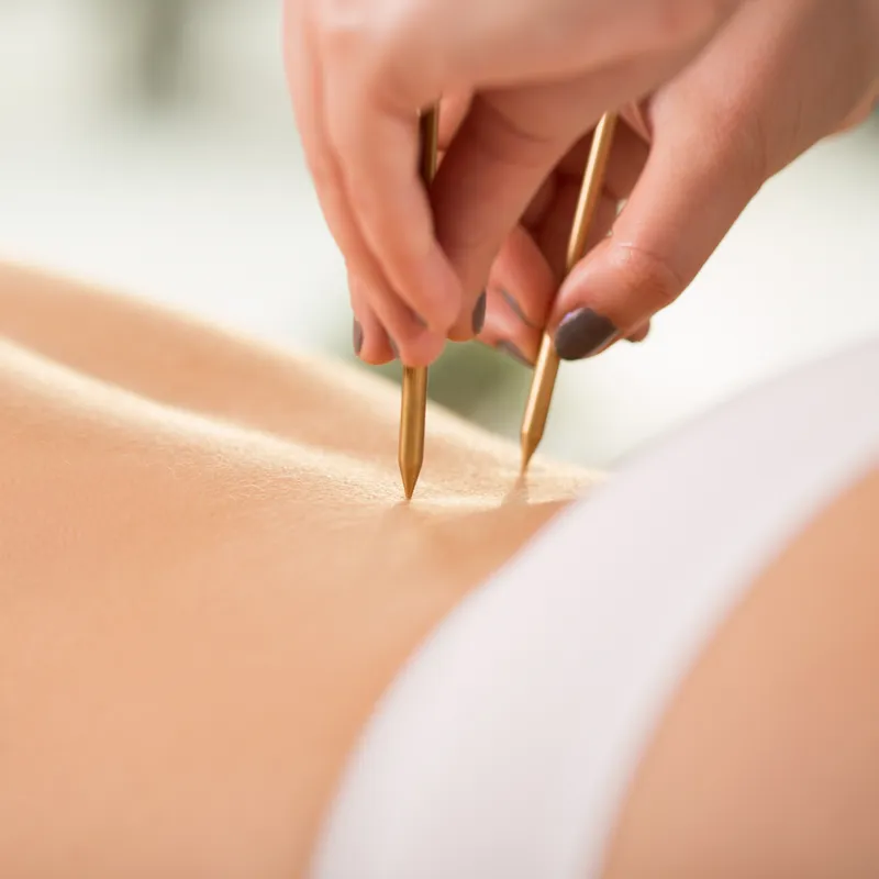 Close-up of acupuncture on young woman's back